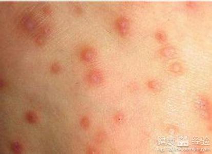 疥疮与湿疹如何区别