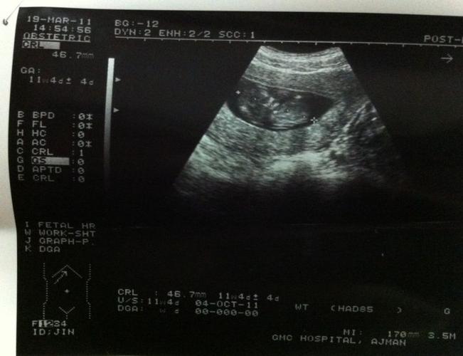 11周4天b超,看到宝宝在"跳舞"