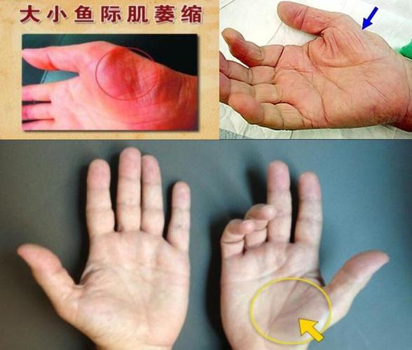 图5"鼠标手"晚期引起手掌鱼际肌群萎缩,瘫痪