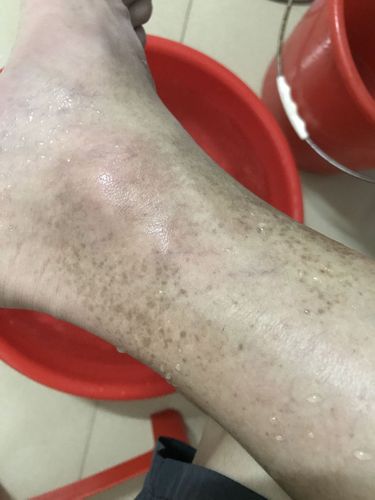 请问脚上这些斑点怎么去除?