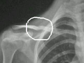 脊柱骨折往往不易发现,但其实它又是有症状的,老年人最常见腰背锁骨