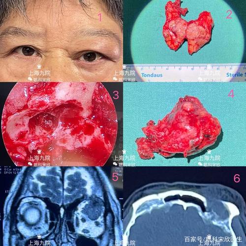 陈阿姨的故事—泪腺肿瘤外院做过2次手术均复发