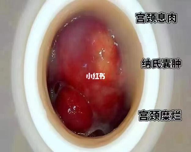 【幸孕妈妈女性科普时间】 好多人问我,宫颈囊肿是什么71 宫颈囊肿