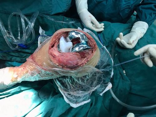 术中假体植入后.