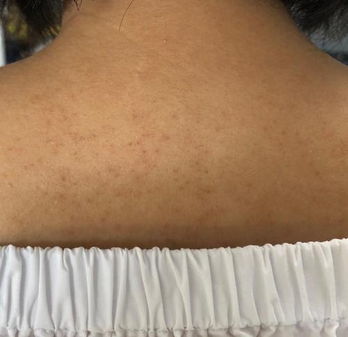 背后长小红点请问如何治疗 哭了