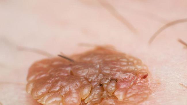 网易首页>网易号>正文申请入驻> 建议30岁以上的女性,定期去医院做hpv