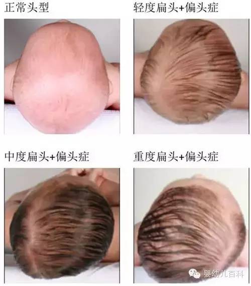 扁头综合征的介绍