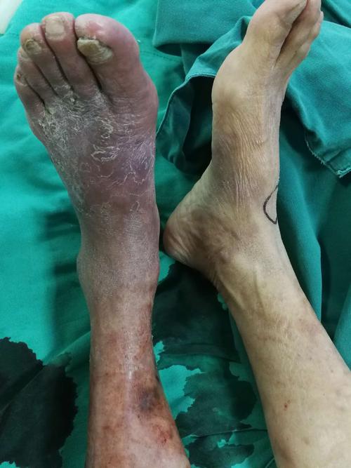 一例下肢动脉硬化闭塞症患者的腔内治疗