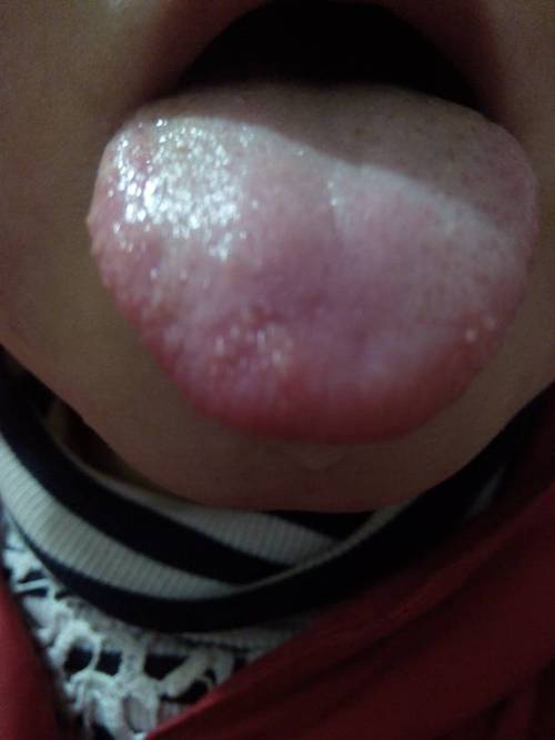 我家孩子4岁,舌头上起的一点一点的泡泡,是烂嘴还是手足口病?