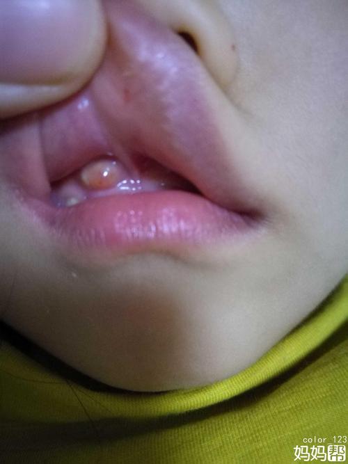 宝宝门牙牙龈上长了个脓包,是怎么回事啊?