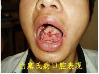 氏病是一种全身性的,慢性血管炎疾病,常常伴随的症状表现就是口腔溃疡