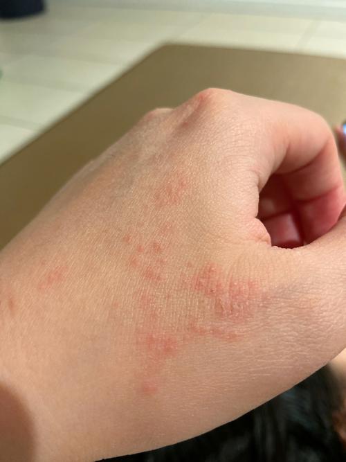 手背上一半长红点,一半干裂,太难了_湿疹_brisbane casino towers自由