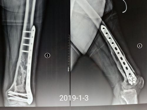 股骨干骨折术后感染不愈合