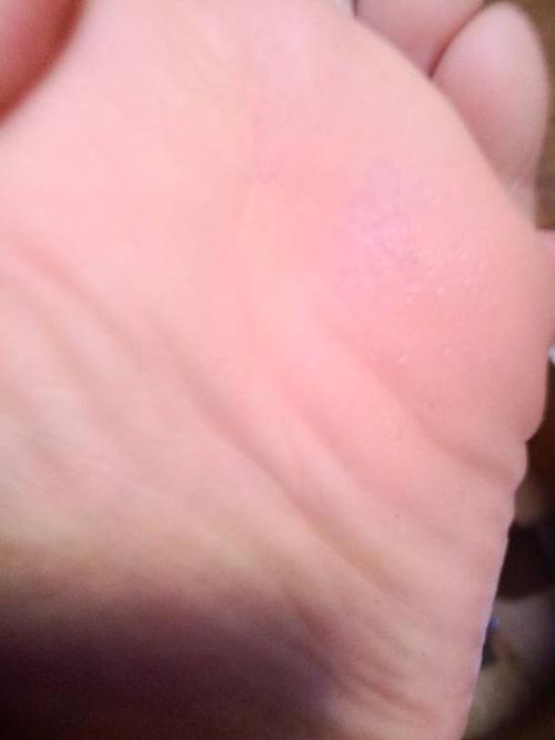 脚底有小坑,之前因为脚总出汗所以用醋泡了