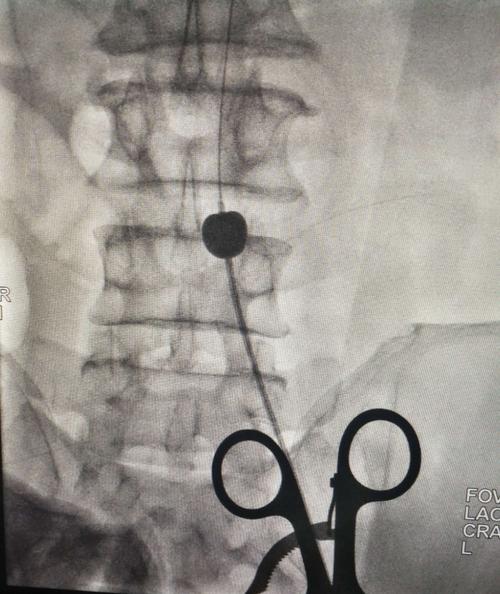 腹主动脉骑跨栓塞的介入治疗