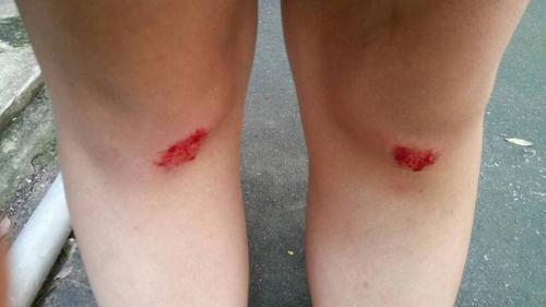 问:腿摔了,涂什么才能祛疤,什么时候涂好?谢谢