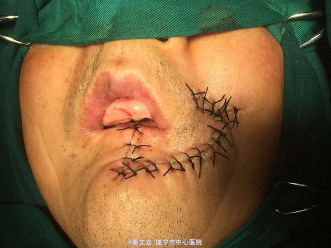 左下唇癌扩大切除后单侧扇形瓣修复一例