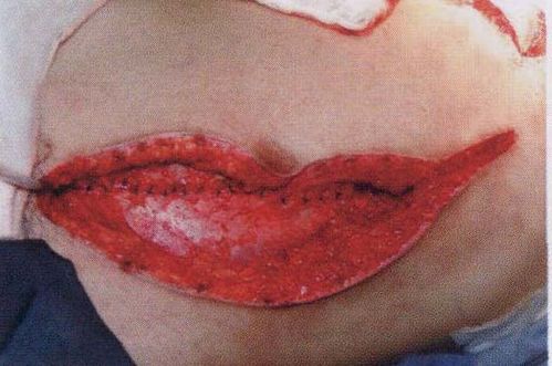 典型病例:岛状腹直肌肌皮瓣修复右胸壁骨肉瘤切除后全