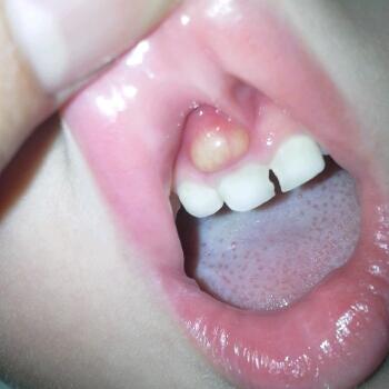 宝宝牙龈上长的什么呀吓死妈妈了