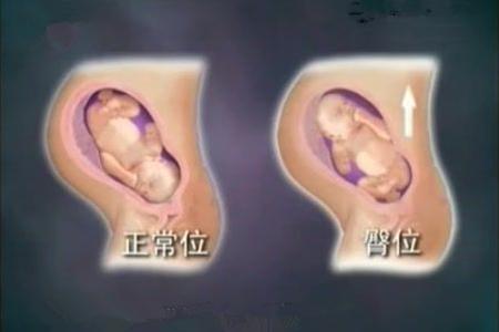 胎位不正的几大元凶,竟然是ta !