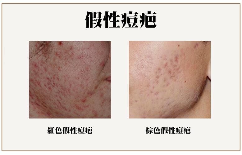 假性痘疤型态与治疗方法