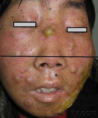 未确诊面部溃疡周身脓疱