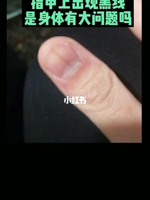 像你指甲上出现的这些黑色竖纹,我们一般叫做送行,黑甲不是什么假黑