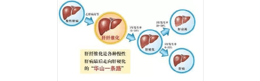 肝纤维化的产生于防治