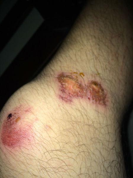 膝盖受伤该怎么办