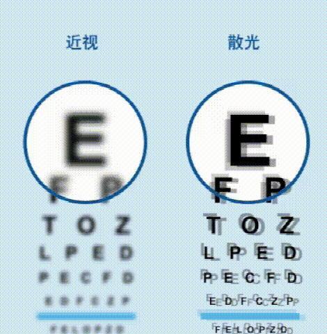散光是眼睛屈光异常的表现,与眼睛角膜的弧度有密切的关系.