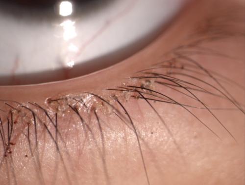 怎样判断自己是否得了阴虱