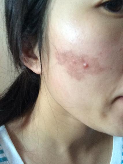 五滴精油在化妆棉上敷脸,当时感觉有点疼,以为很正常,像风油精的感觉