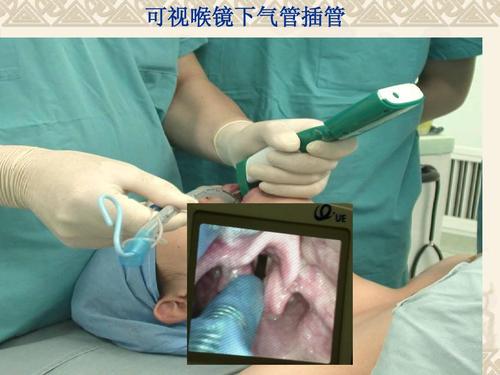 可视喉镜下气管插管