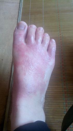 我的脚是怎么了,疼死了,开始是一点点腐烂现在是整只脚