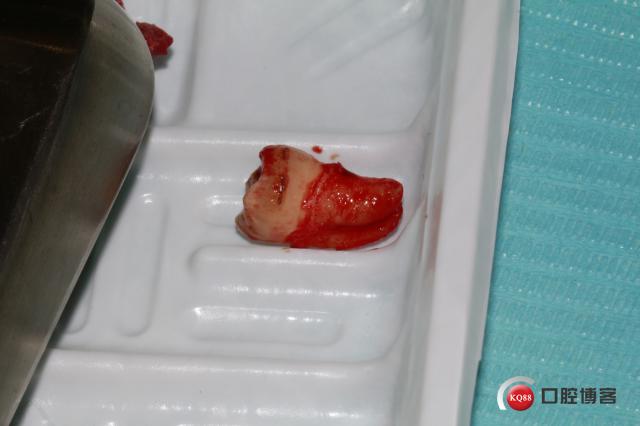 拔牙创口,清理周边肉芽,切忌,不能搔刮.