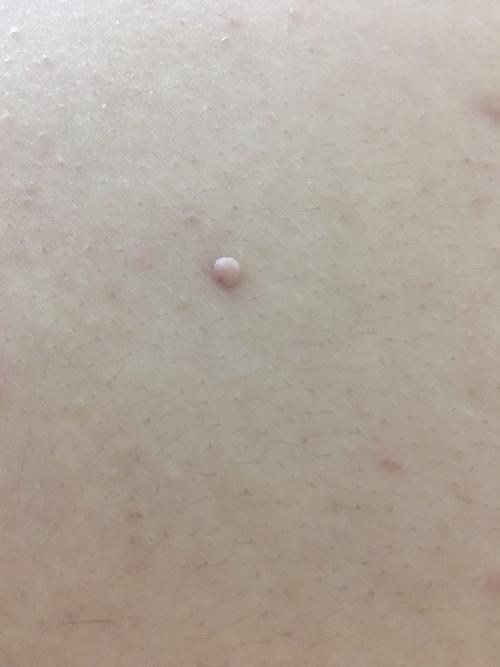 背上长肉色的小疙瘩是什么东西来的