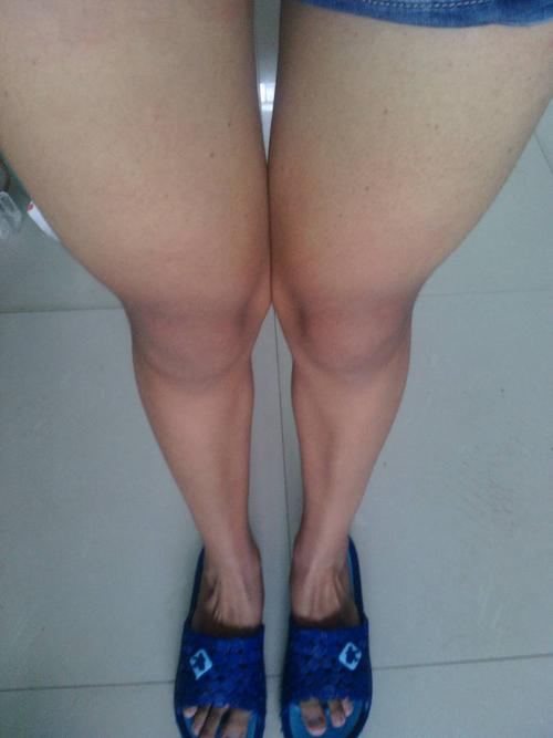 这样的腿形正常吗,我感觉大腿太粗,小腿很细