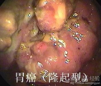 胃癌中期的症状是什么