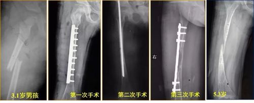 创伤两个儿童股骨干骨折争议病例之元芳你怎么看