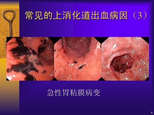 卫生 上消化道出血的诊治ppt  图文并茂 常见的上消化道出血病因(3