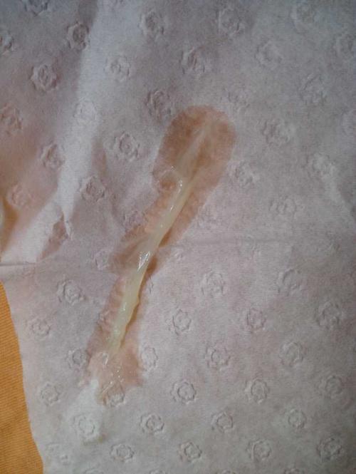 麻烦姐妹们帮我看下这样的白带是怎么回事,图片恶心到大家实在不好