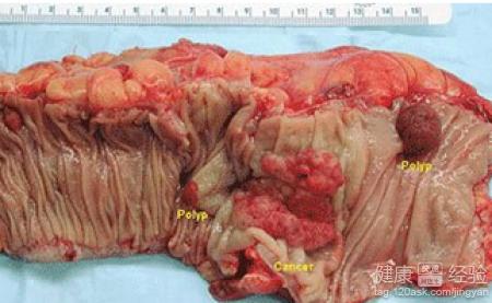 大肠癌疾病问题很严重的,一般发病的都是老年人,包括结肠癌和直肠癌
