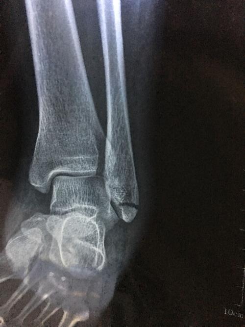 拍片结果说是左外踝骨折断端分离,关节间隙正常范围.