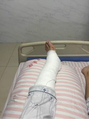 踝关节骨折多久能康复