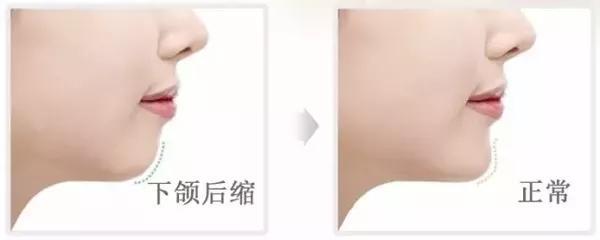 又土气又显穷的面相和地包天一样丑的没下巴不治不行