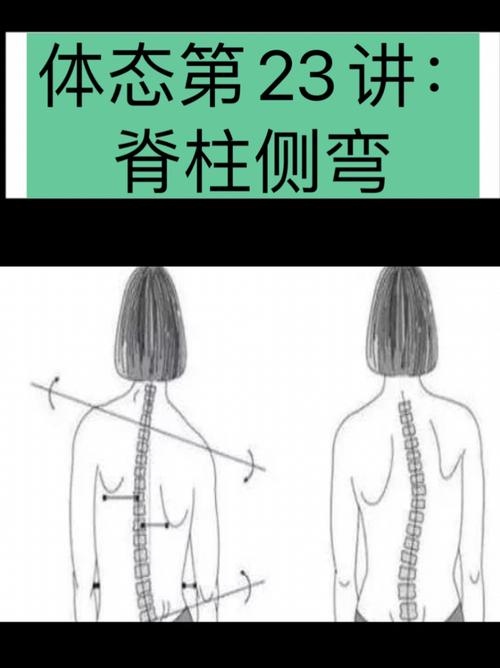 体态第23讲脊柱侧弯拒绝吊单杠牵引和支具