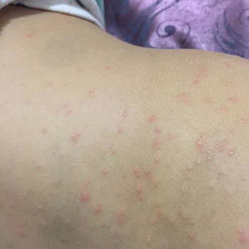 身上脸上手上都长了很多疹子,做血常规医生说是病毒疹