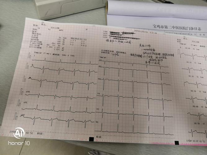 一例右位心患者心电图