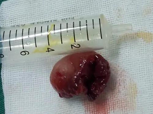 10月10日,普外科团队为李奶奶手术,由于息肉较大,女性尿道口短,操作