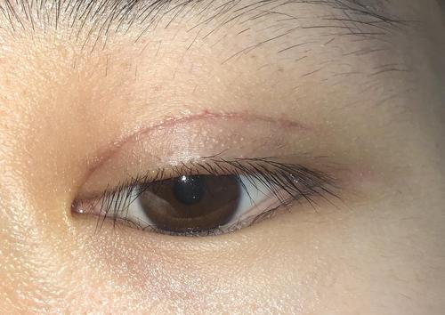 两个半小时 可以看到我眼球是真的好凸,好烦哦 12.03晚上 12.